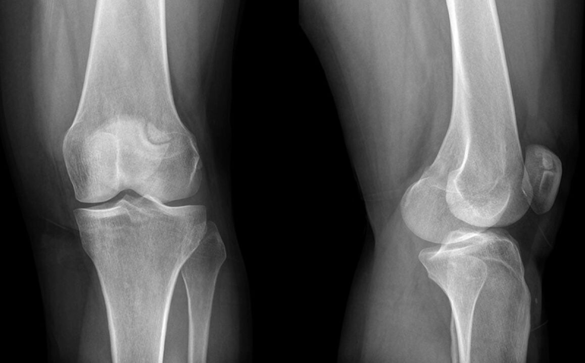 L'osteoartrite del ginocchio sui raggi X prima di usare l'organizzazione
