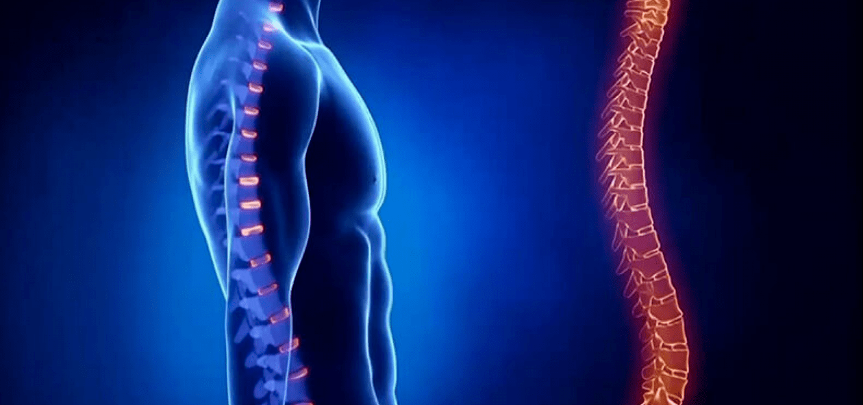 Lesioni spinali dovute a osteocondrosi