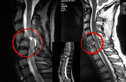 Compressione del midollo spinale indicazione all’intervento chirurgico